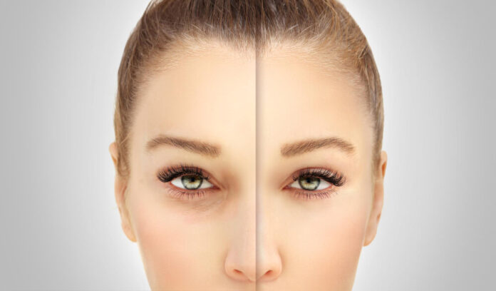 Blepharoplasty: Opening The Eyes To A Brighter Visual Future